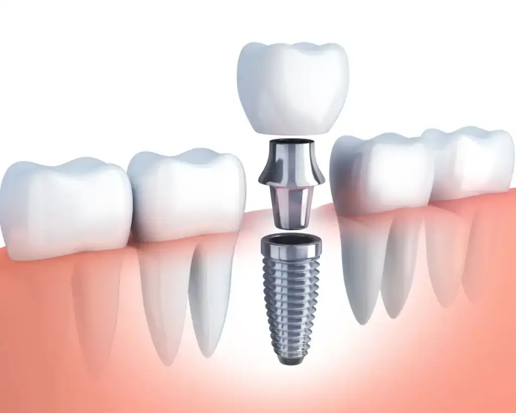 Dental Implants in