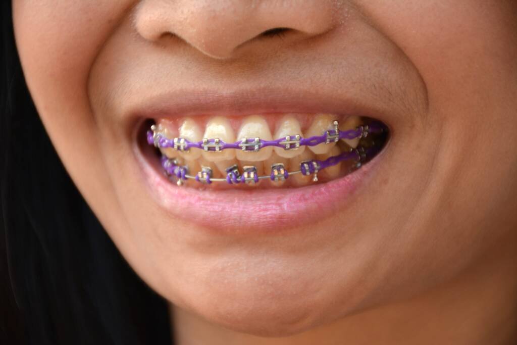 Power Chain in Orthodontics