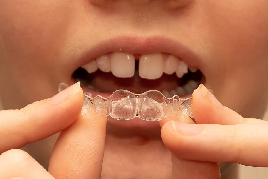 Invisalign for Teens