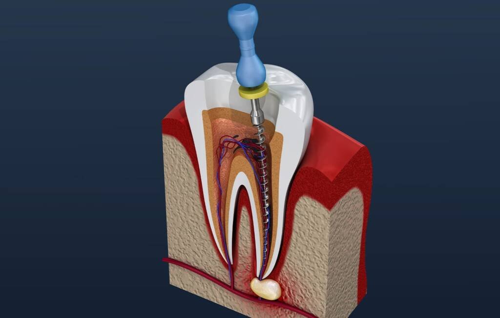 Root Canal Therapy
