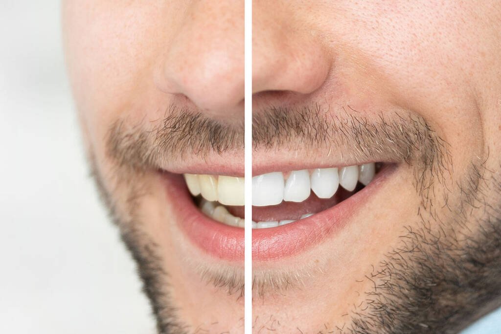 Professional Teeth Whitening