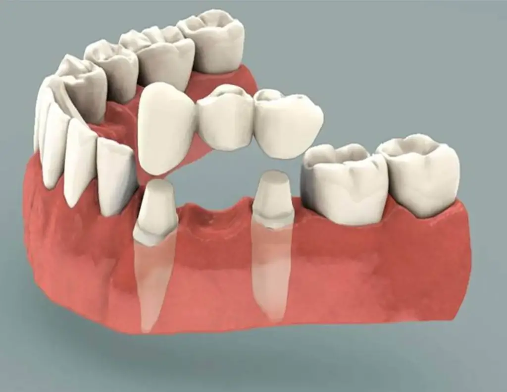 Dental Bridges