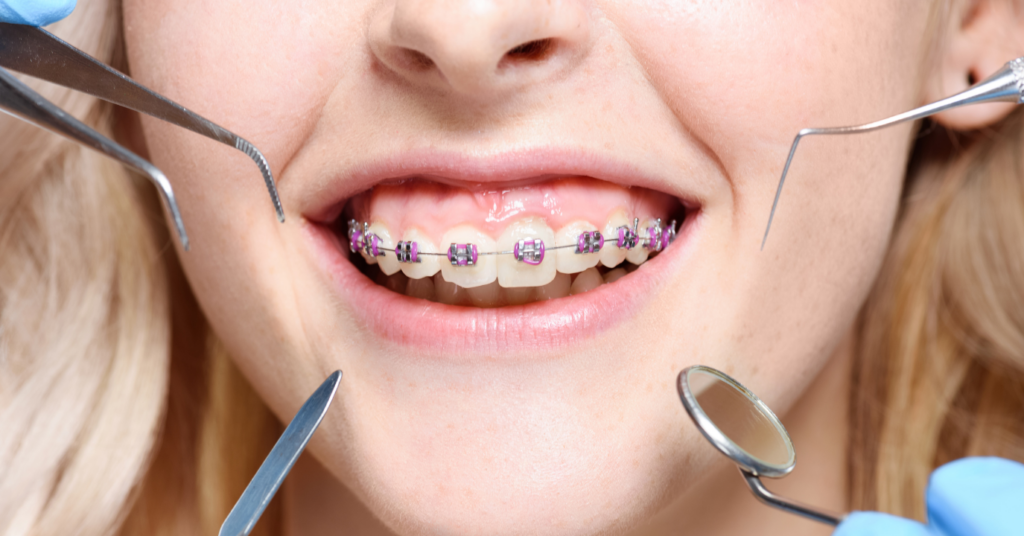 Dental Braces Treatment