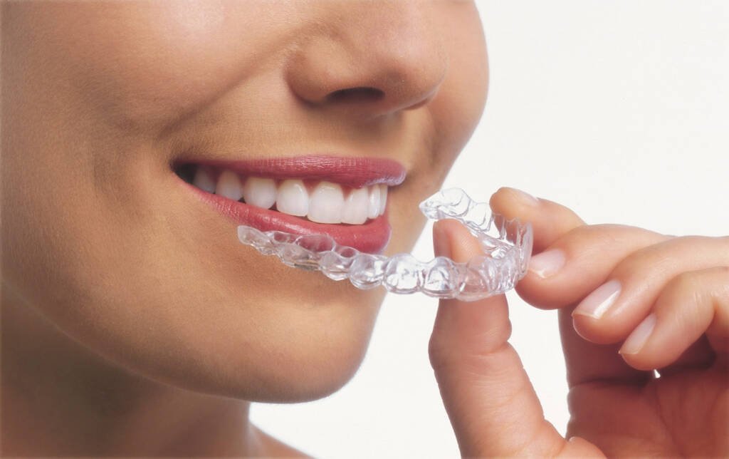 Invisalign Clear Aligners