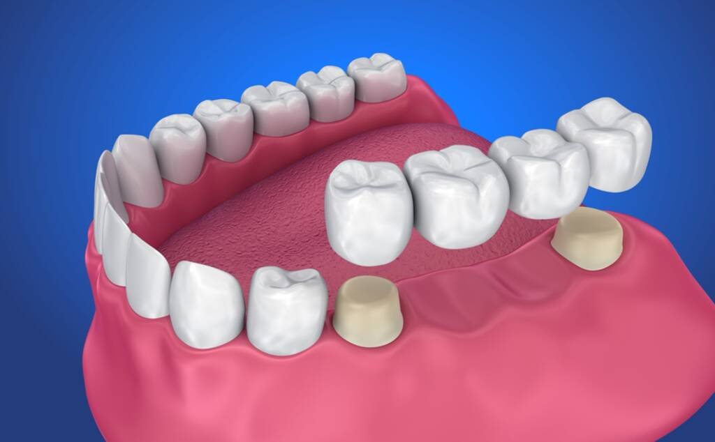Dental Bridges