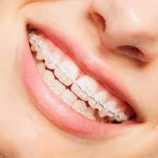 Invisalign Clear Aligners