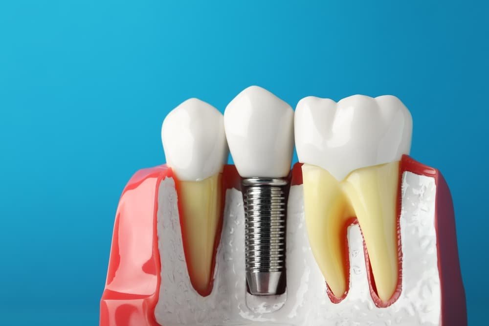 Dental Implants in Shivaji Nagar