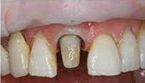 Root canal treatment in Bangalore