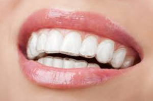 What are Invisible Braces?