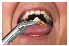 How to prepare for tooth extraction?