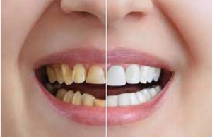 Cosmetic Dentistry To Improve Your Smile