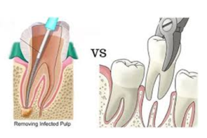 Root Canal VS Extraction