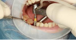 Dental Implant surgery side effects