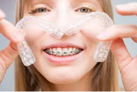 Clear Aligner Treatment