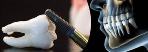 Dental Implant Surgery