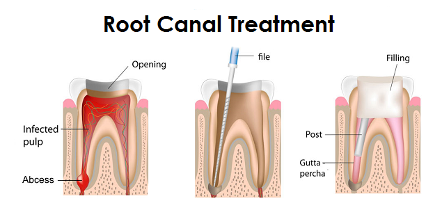 Root Canal Treatment In HRBR Layout