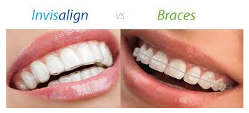 Cost Of Invisalign Clear Aligners
