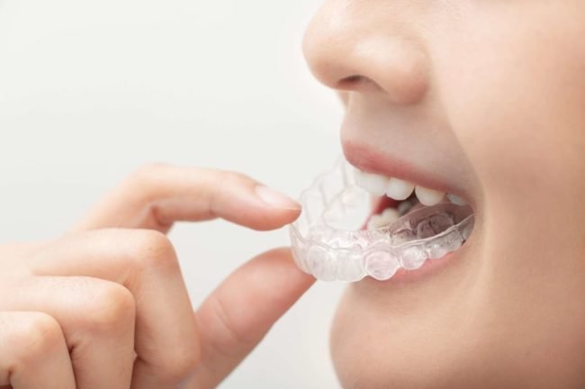 Orthodontic Treatments