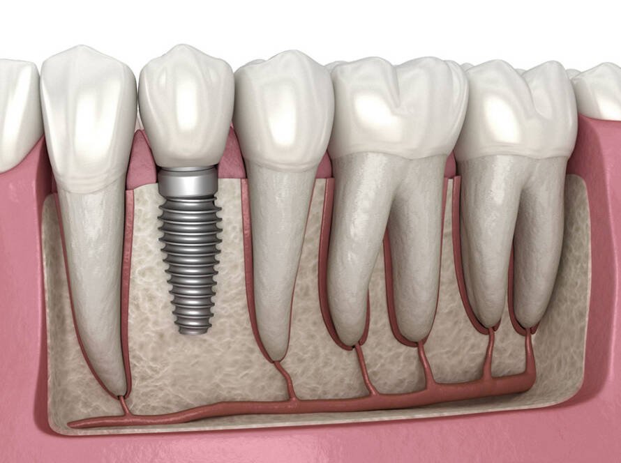 Dental Implants