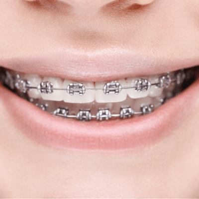 Traditional Braces