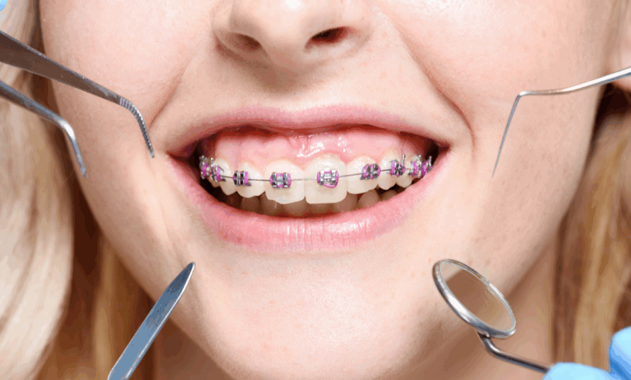 Dental Braces Treatment