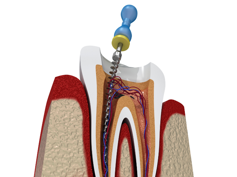 Root Canal Treatment
