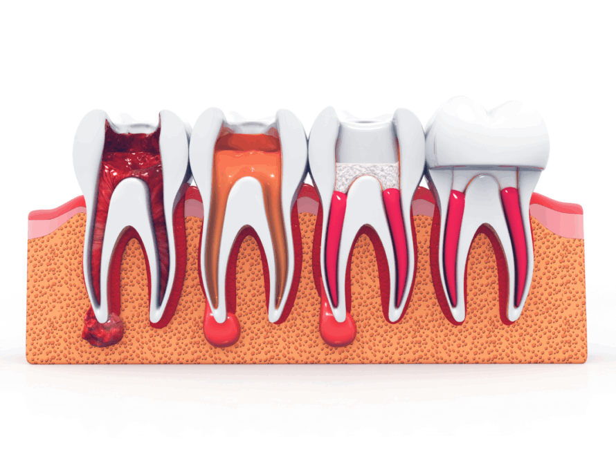 Root Canal Treatment