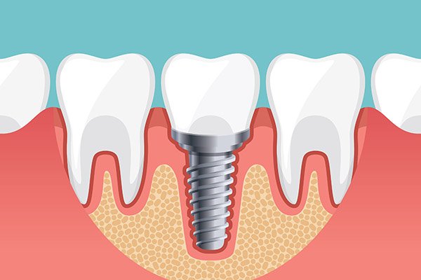 Dental Implants