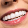 Invisalign Clear Aligners in RT Nagar