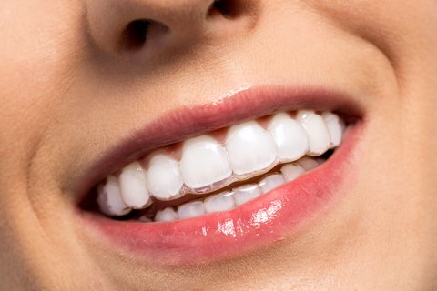 Invisalign Clear Aligners