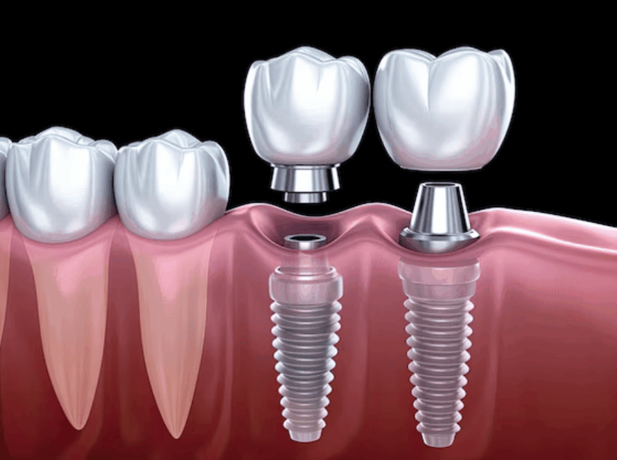 Dental Implants
