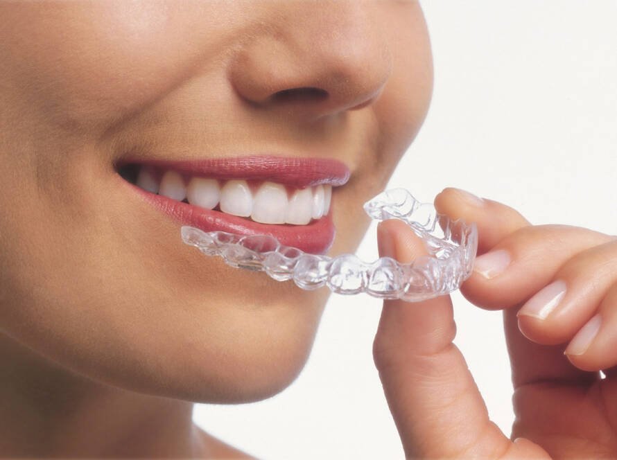 Invisalign Clear Aligners