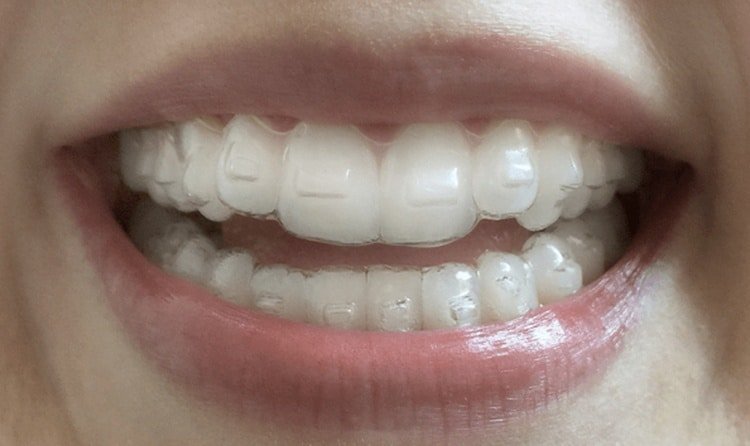 Spark Clear Aligners