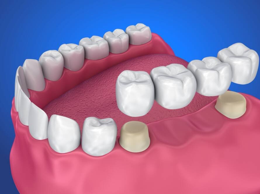 Dental Bridges
