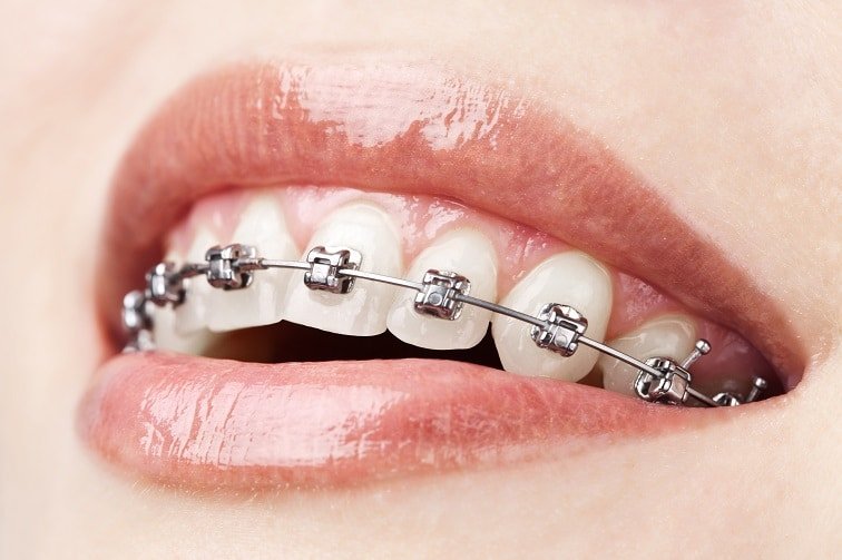 Orthodontic Braces