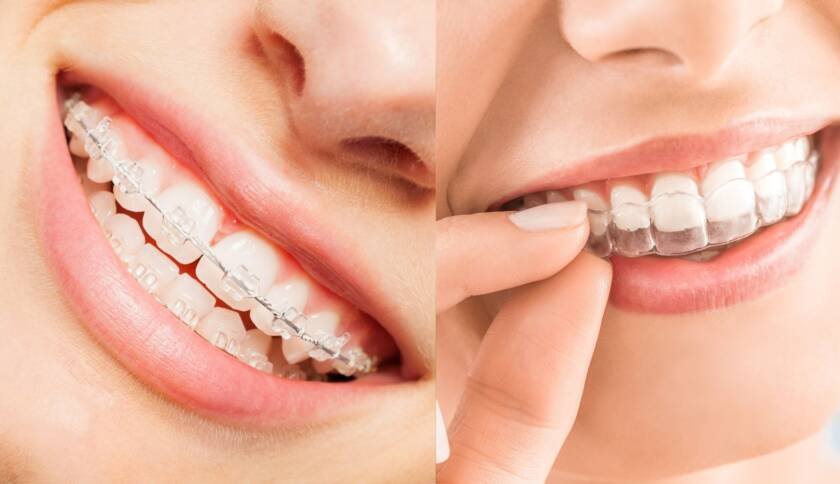 Invisalign Clear Aligners
