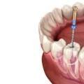 ROOT CANAL TREATMENT IN VASANTH NAGAR