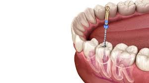 ROOT CANAL TREATMENT
