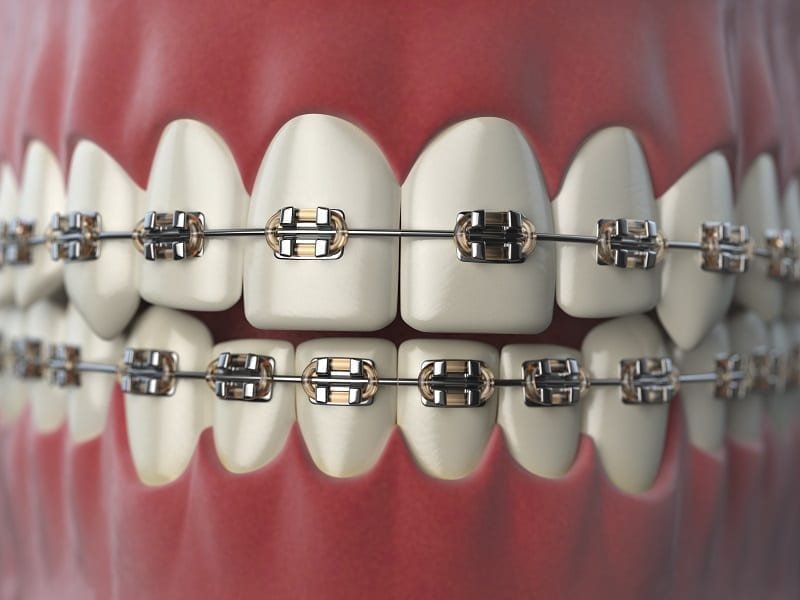 Dental braces