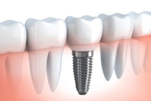 Dental Implants