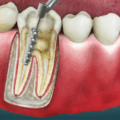 Root Canal Treatment in Shivaji Nagar
