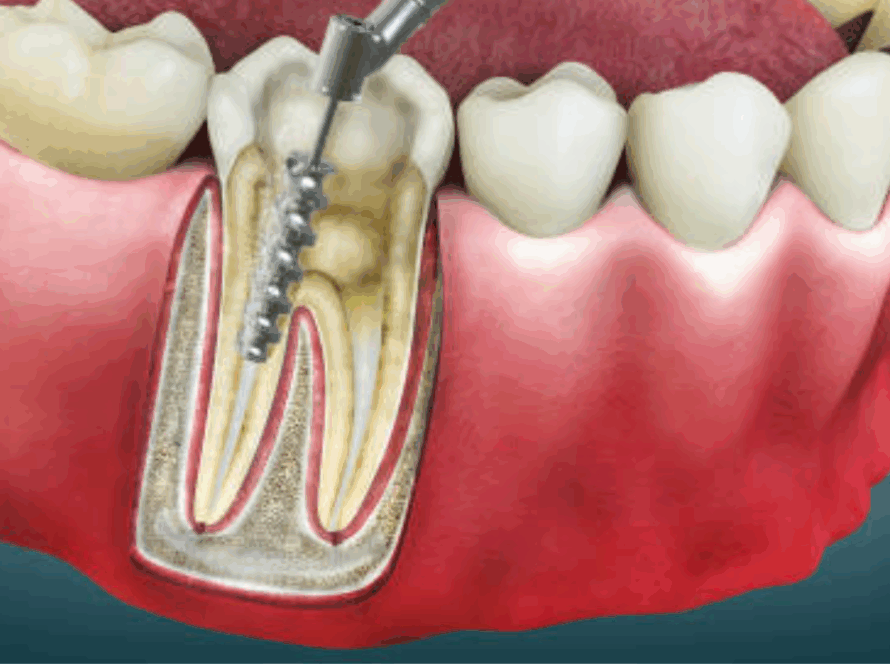 Root Canal Treatment