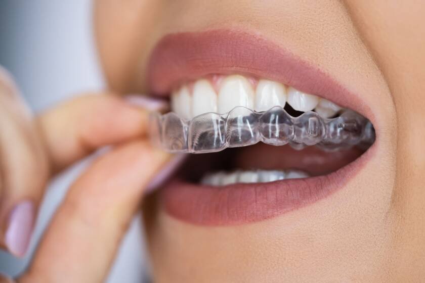 Spark Clear Aligners
