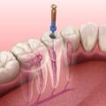 Tooth Root Canal Dentist Near Cunningham Road