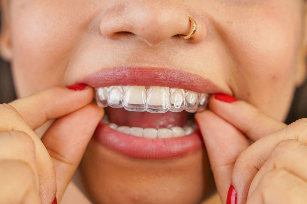 Spark Clear Aligners