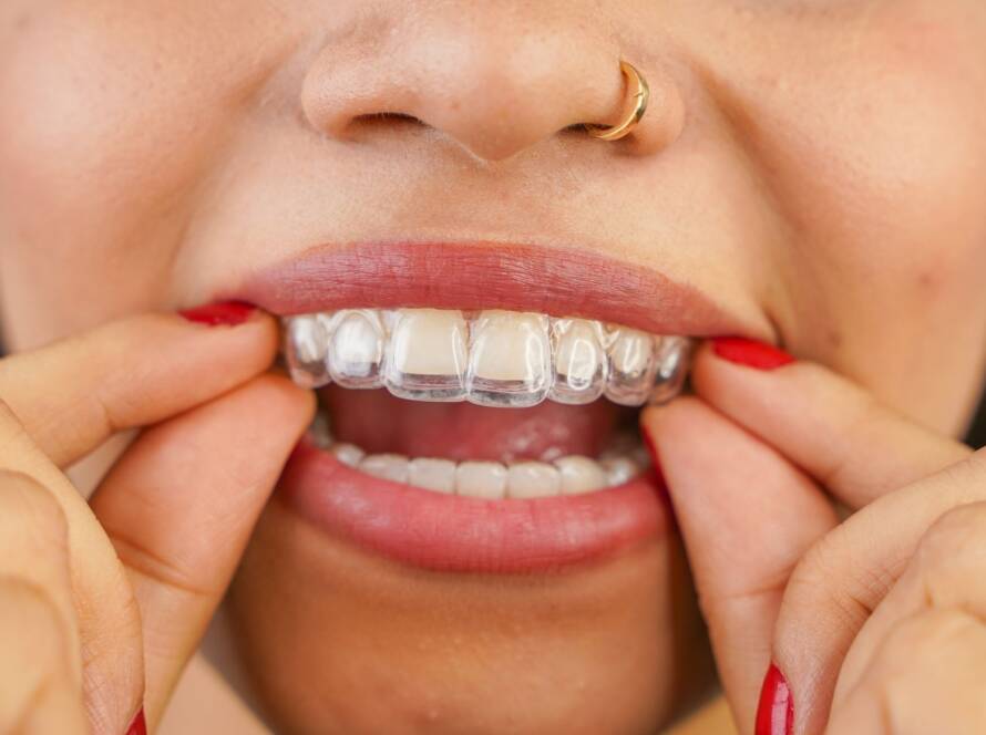 Spark Clear Aligners