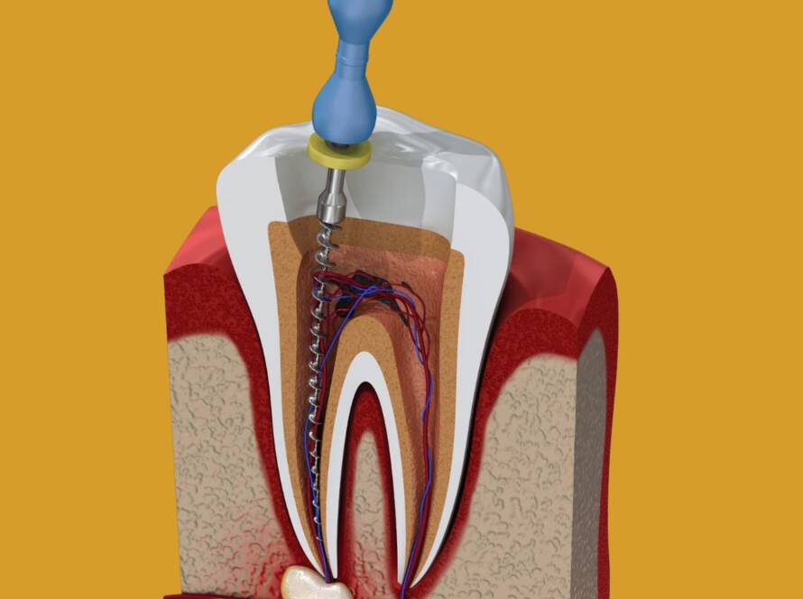 Root Canal Treatment