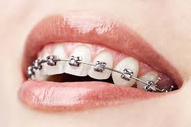 Damon Braces