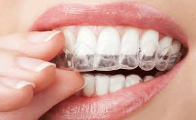 Invisalign