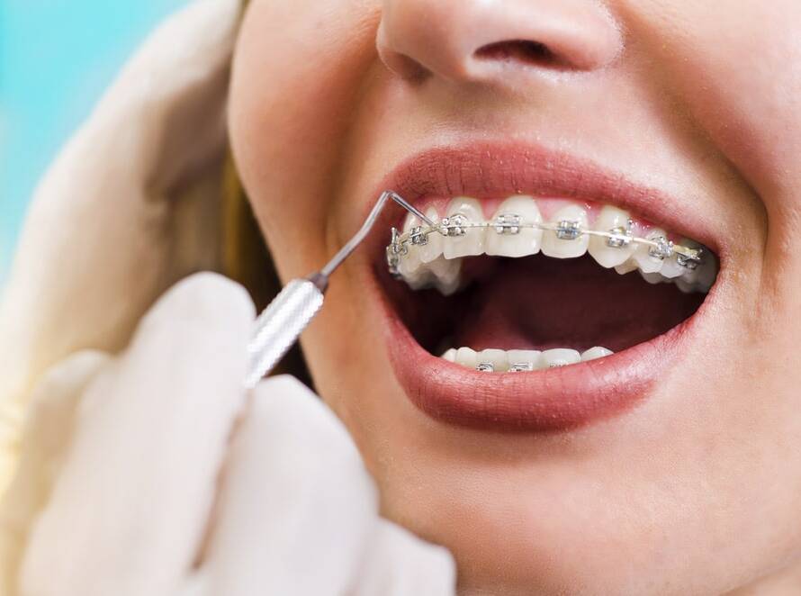 Orthodontic Treatment in Vasanth Nagar
